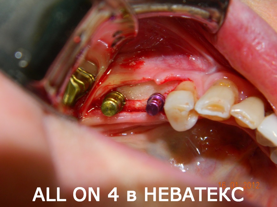 Фото протеза All on 4 протез all on 4 фото